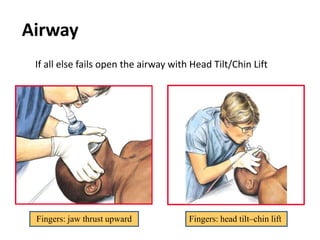 Fingers: jaw thrust upward Fingers: head tilt–chin lift
Airway
If all else fails open the airway with Head Tilt/Chin Lift
 