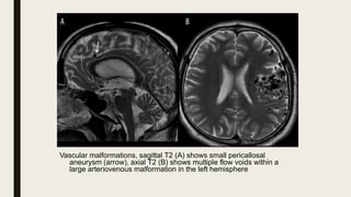 Basic and advanced mri imaging sequences in brain | PPTX