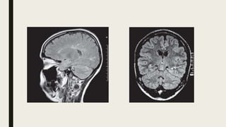 Basic and advanced mri imaging sequences in brain | PPTX