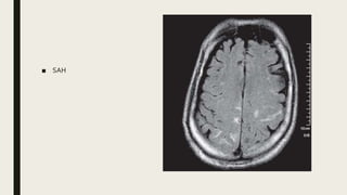 Basic and advanced mri imaging sequences in brain | PPTX