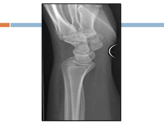 Basic and supplementary projections of thumb and scaphoid | PPTX