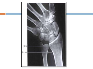 Basic and supplementary projections of thumb and scaphoid | PPTX