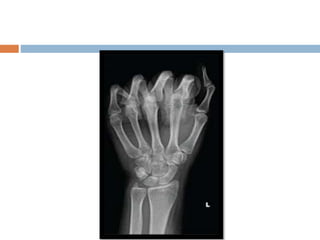 Basic and supplementary projections of thumb and scaphoid | PPTX