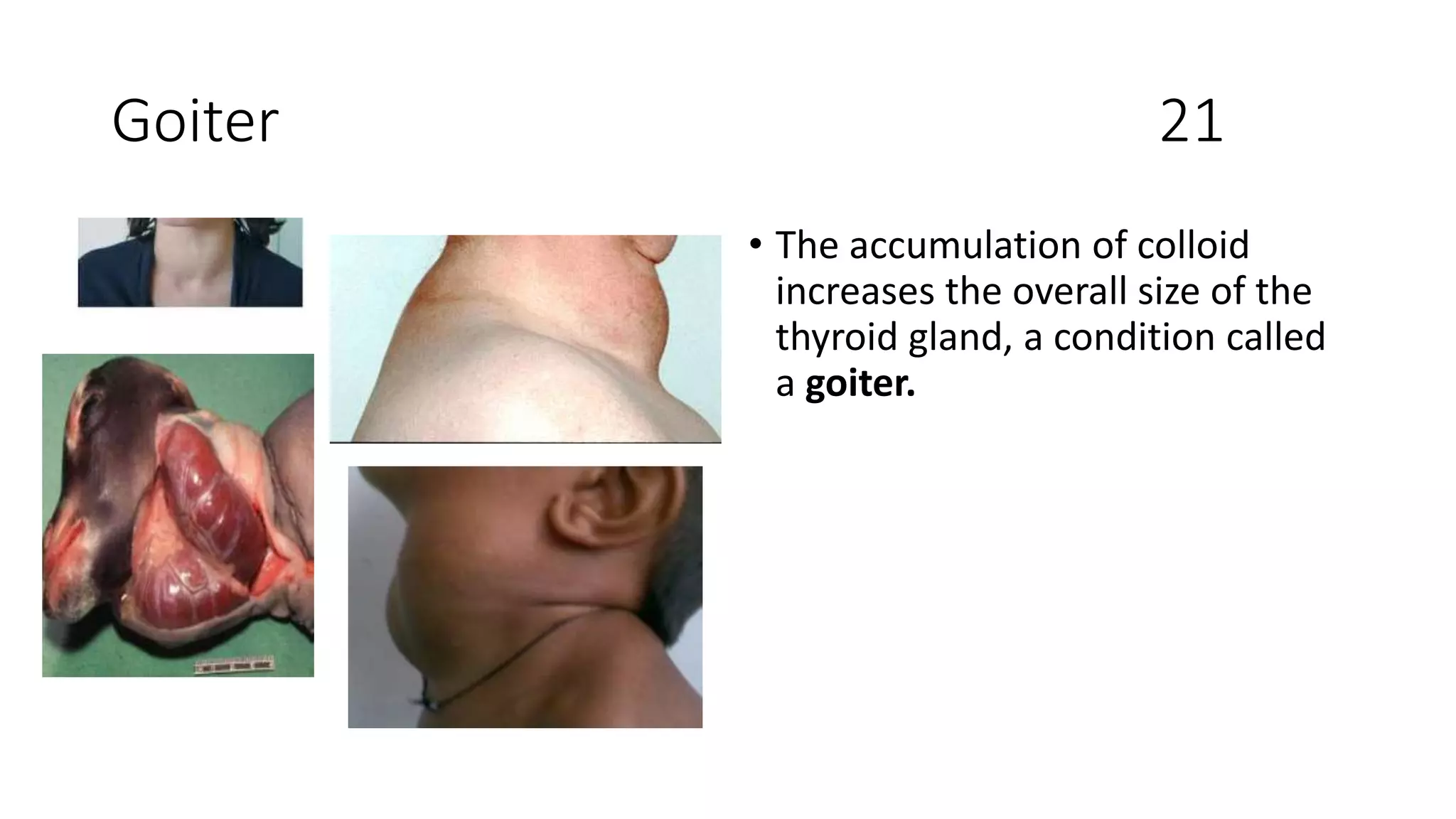 Goiter 21
• The accumulation of colloid
increases the overall size of the
thyroid gland, a condition called
a goiter.
 