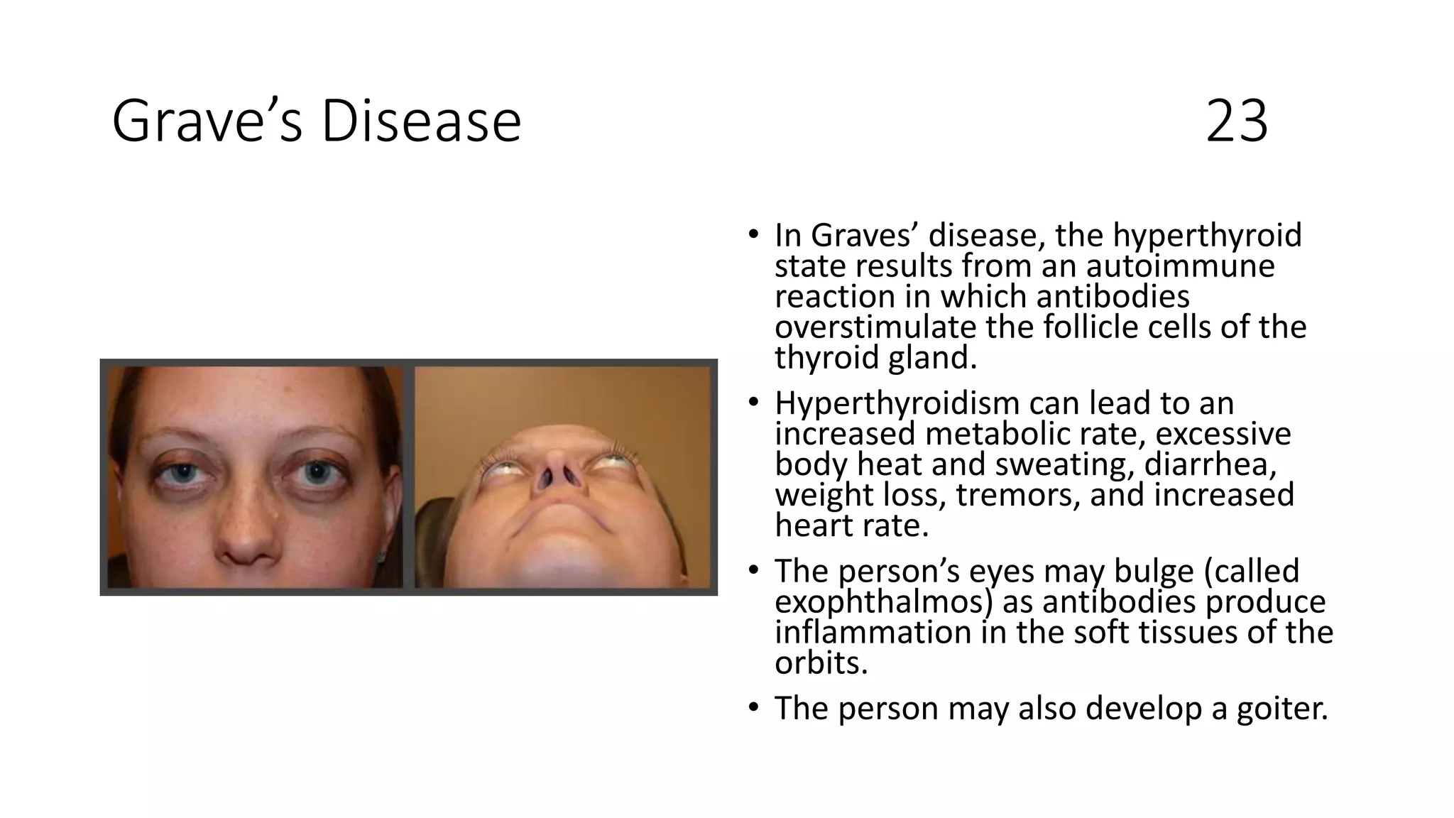 Grave’s Disease 23
• In Graves’ disease, the hyperthyroid
state results from an autoimmune
reaction in which antibodies
overstimulate the follicle cells of the
thyroid gland.
• Hyperthyroidism can lead to an
increased metabolic rate, excessive
body heat and sweating, diarrhea,
weight loss, tremors, and increased
heart rate.
• The person’s eyes may bulge (called
exophthalmos) as antibodies produce
inflammation in the soft tissues of the
orbits.
• The person may also develop a goiter.
 