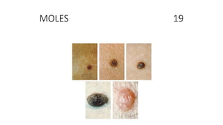 MOLES 19
 