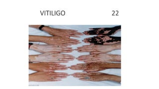 VITILIGO 22
 