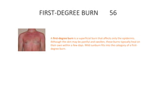 FIRST-DEGREE BURN 56
A first-degree burn is a superficial burn that affects only the epidermis.
Although the skin may be painful and swollen, these burns typically heal on
their own within a few days. Mild sunburn fits into the category of a first-
degree burn.
 