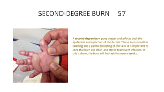 SECOND-DEGREE BURN 57
A second-degree burn goes deeper and affects both the
epidermis and a portion of the dermis. These burns result in
swelling and a painful blistering of the skin. It is important to
keep the burn site clean and sterile to prevent infection. If
this is done, the burn will heal within several weeks.
 