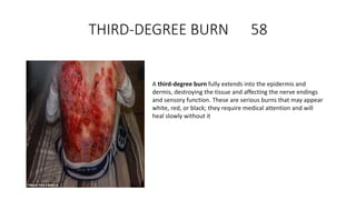 THIRD-DEGREE BURN 58
A third-degree burn fully extends into the epidermis and
dermis, destroying the tissue and affecting the nerve endings
and sensory function. These are serious burns that may appear
white, red, or black; they require medical attention and will
heal slowly without it
 