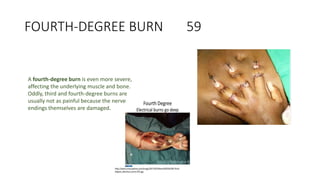 FOURTH-DEGREE BURN 59
A fourth-degree burn is even more severe,
affecting the underlying muscle and bone.
Oddly, third and fourth-degree burns are
usually not as painful because the nerve
endings themselves are damaged.
 