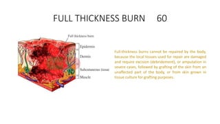FULL THICKNESS BURN 60
Full-thickness burns cannot be repaired by the body,
because the local tissues used for repair are damaged
and require excision (debridement), or amputation in
severe cases, followed by grafting of the skin from an
unaffected part of the body, or from skin grown in
tissue culture for grafting purposes.
 