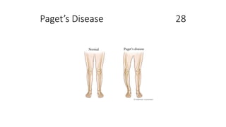 Paget’s Disease 28
 