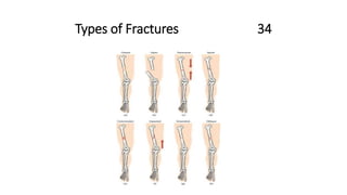 Types of Fractures 34
 