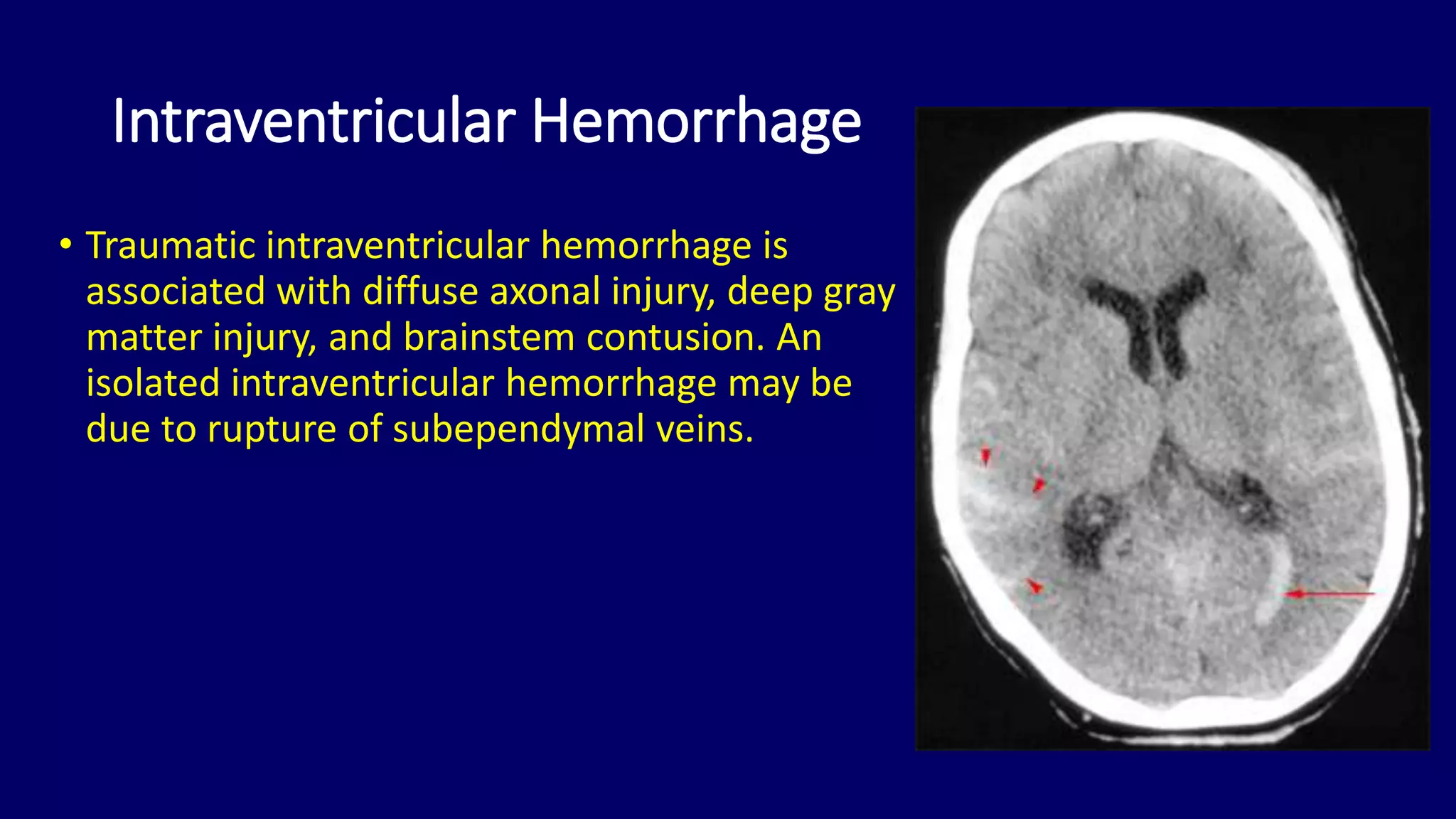 Intraventricular Rupture Basic approach to brain CT Dr. Muhammad Bin Zulfiqar | PPTX