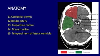 Basic approach to brain CT Dr. Muhammad Bin Zulfiqar