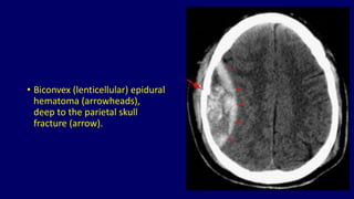 Basic approach to brain CT Dr. Muhammad Bin Zulfiqar