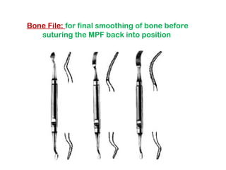 Bone File: for final smoothing of bone before
suturing the MPF back into position
 