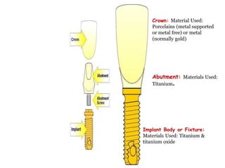 Crown: Material Used:
Porcelains (metal supported
or metal free) or metal
(normally gold)
Abutment: Materials Used:
Titanium.
Implant Body or Fixture:
Materials Used: Titanium &
titanium oxide
 