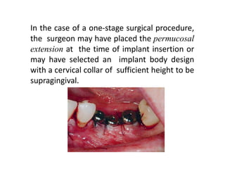In the case of a one-stage surgical procedure,
the surgeon may have placed the permucosal
extension at the time of implant insertion or
may have selected an implant body design
with a cervical collar of sufficient height to be
supragingival.
 