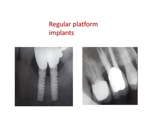 Regular platform
implants
 