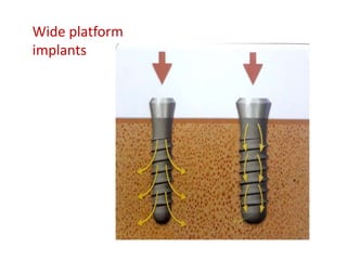 Wide platform
implants
 