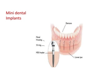 Mini dental
Implants
 