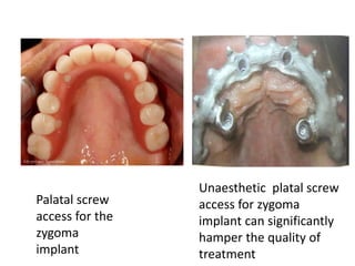 Palatal screw
access for the
zygoma
implant
Unaesthetic platal screw
access for zygoma
implant can significantly
hamper the quality of
treatment
 