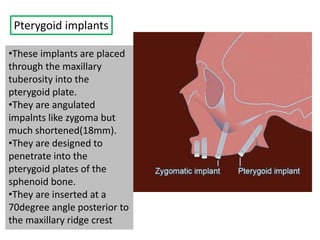 Pterygoid implants
•These implants are placed
through the maxillary
tuberosity into the
pterygoid plate.
•They are angulated
impalnts like zygoma but
much shortened(18mm).
•They are designed to
penetrate into the
pterygoid plates of the
sphenoid bone.
•They are inserted at a
70degree angle posterior to
the maxillary ridge crest
 
