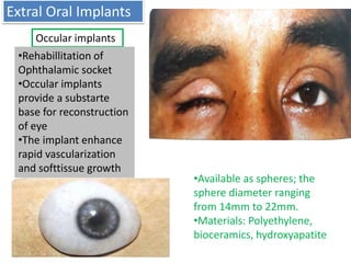 Extral Oral Implants
Occular implants
•Rehabillitation of
Ophthalamic socket
•Occular implants
provide a substarte
base for reconstruction
of eye
•The implant enhance
rapid vascularization
and softtissue growth
•Available as spheres; the
sphere diameter ranging
from 14mm to 22mm.
•Materials: Polyethylene,
bioceramics, hydroxyapatite
 