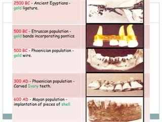 2500 BC - Ancient Egyptians -
gold ligature.
500 BC - Etruscan population -
gold bands incorporating pontics.
500 BC - Phoenician population -
gold wire.
300 AD - Phoenician population -
Carved Ivory teeth.
600 AD - Mayan population -
implantation of pieces of shell.
 