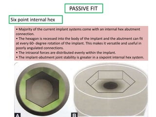 PASSIVE FIT
Six point internal hex
• Majority of the current implant systems come with an internal hex abutment
connection.
• The hexagon is recessed into the body of the implant and the abutment can fit
at every 60- degree rotation of the implant. This makes it versatile and useful in
poorly angulated connections.
• The intraoral forces are distributed evenly within the implant.
• The implant-abutment joint stability is greater in a sixpoint internal hex system.
 