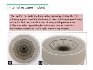 Internal octagon implant
•This system has an 8-sided internal octagonal geometry, thereby
allowing angulation of the abutment at every 45- degree positioning
of the implant over the abutment at every 45-degree rotation.
• The internal octagonal implant-abutment connection offers
minimal rotational and lateral resistance during function.
 