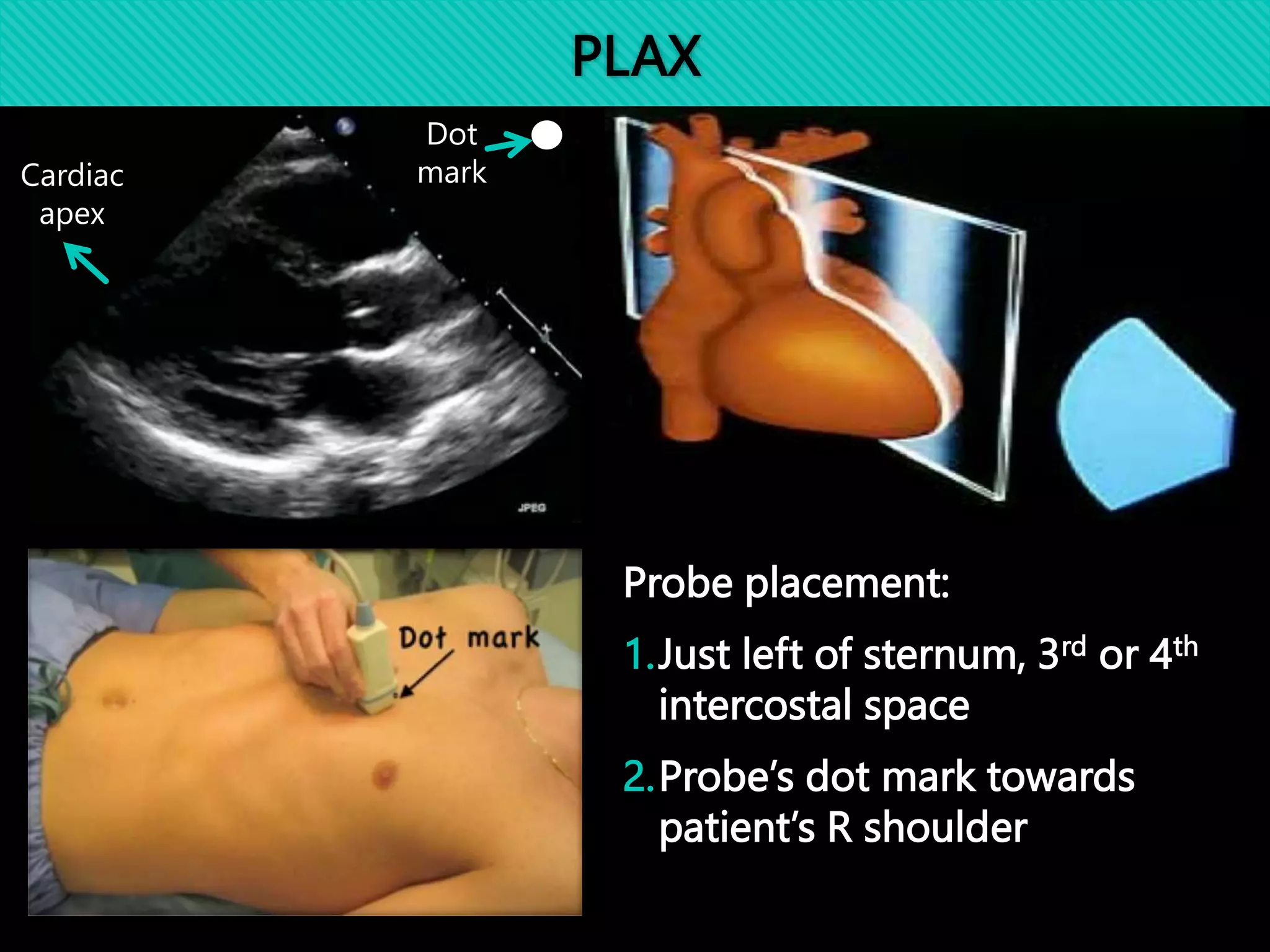 Interpostal Scanning BASIC CARDIAC US.pptx