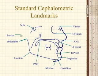 Sella
Porion
Gonion
PNS
Menton Gnathion
Pogonion
B Point
A Point
ANS
Orbitale
Nasion
Articulare
Standard Cephalometric
Landmarks
 