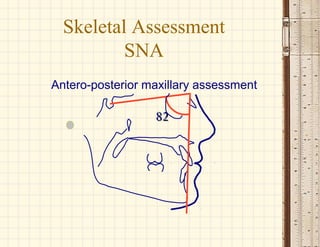 8282
Antero-posterior maxillary assessment
Skeletal Assessment
SNA
 
