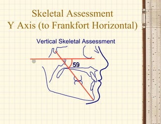 5959
Vertical Skeletal Assessment
Skeletal Assessment
Y Axis (to Frankfort Horizontal)
 