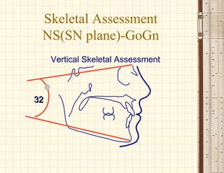 3232
Vertical Skeletal Assessment
Skeletal Assessment
NS(SN plane)-GoGn
 