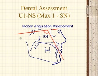 104104
Incisor Angulation Assessment
Dental Assessment
U1-NS (Max 1 - SN)
 