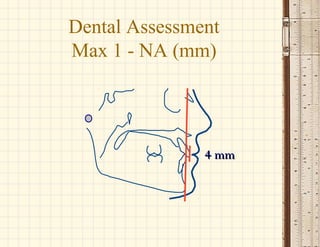 4 mm4 mm
Dental Assessment
Max 1 - NA (mm)
 