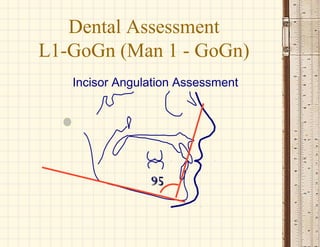 9595
Incisor Angulation Assessment
Dental Assessment
L1-GoGn (Man 1 - GoGn)
 