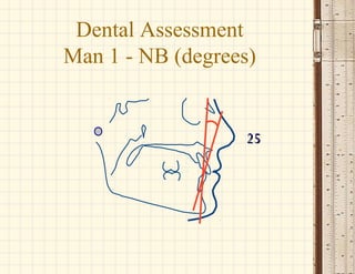2525
Dental Assessment
Man 1 - NB (degrees)
 