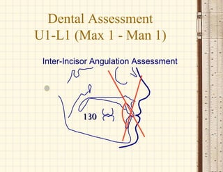 130130
Inter-Incisor Angulation Assessment
Dental Assessment
U1-L1 (Max 1 - Man 1)
 