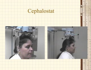 Cephalostat
 