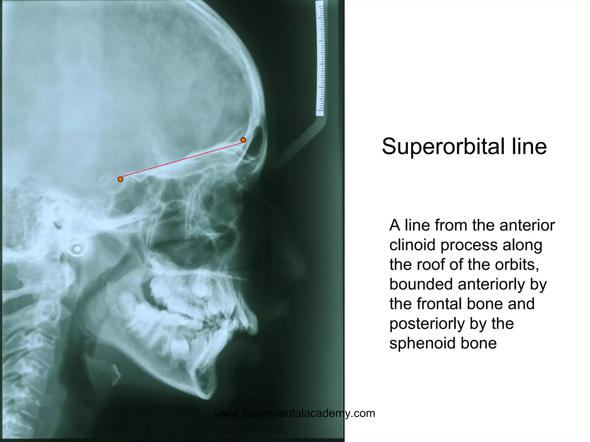 Superorbital line
A line from the anterior
clinoid process along
the roof of the orbits,
bounded anteriorly by
the frontal bone and
posteriorly by the
sphenoid bone
www.indiandentalacademy.com
 