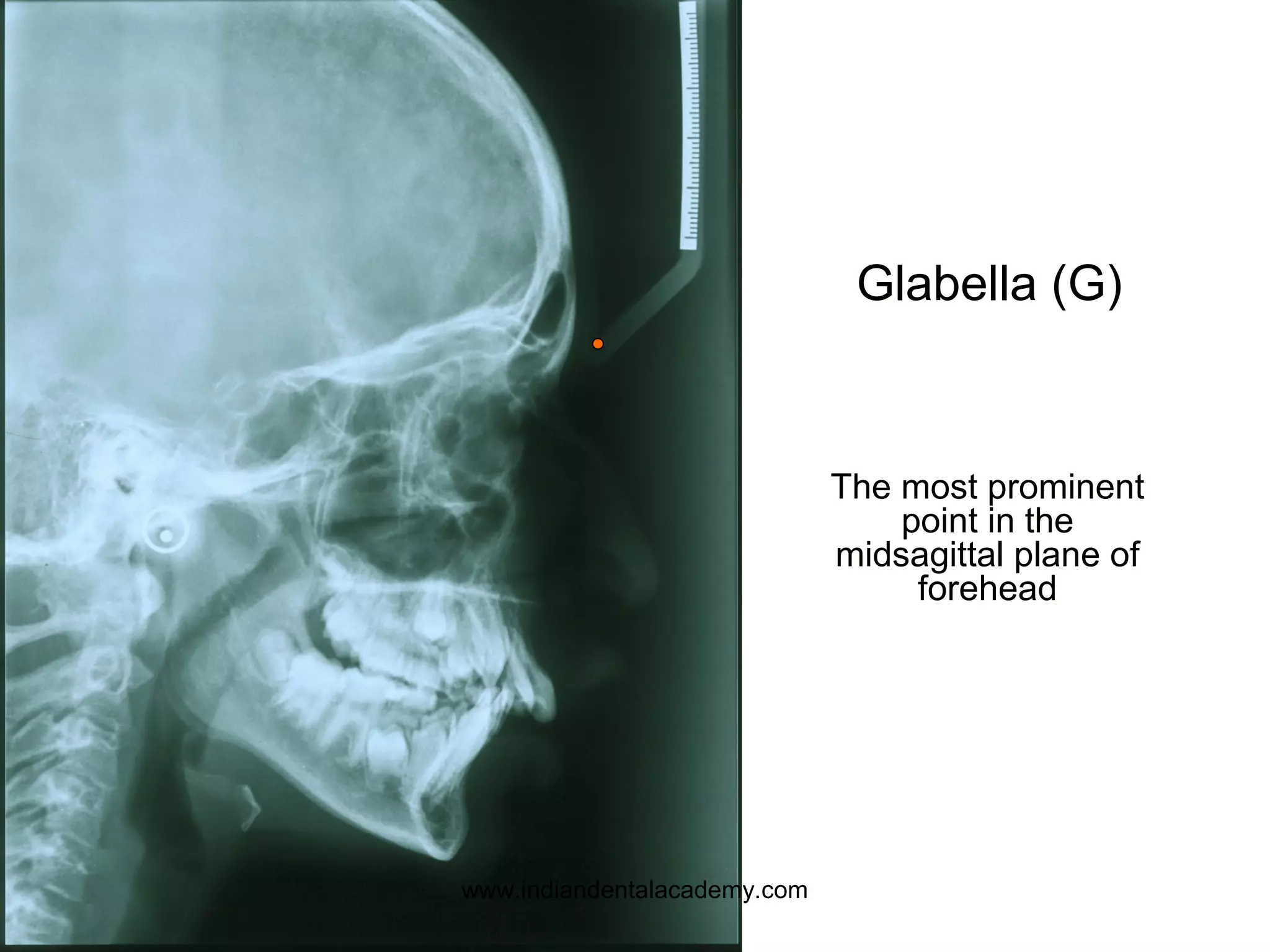 Glabella (G)
The most prominent
point in the
midsagittal plane of
forehead
www.indiandentalacademy.com
 