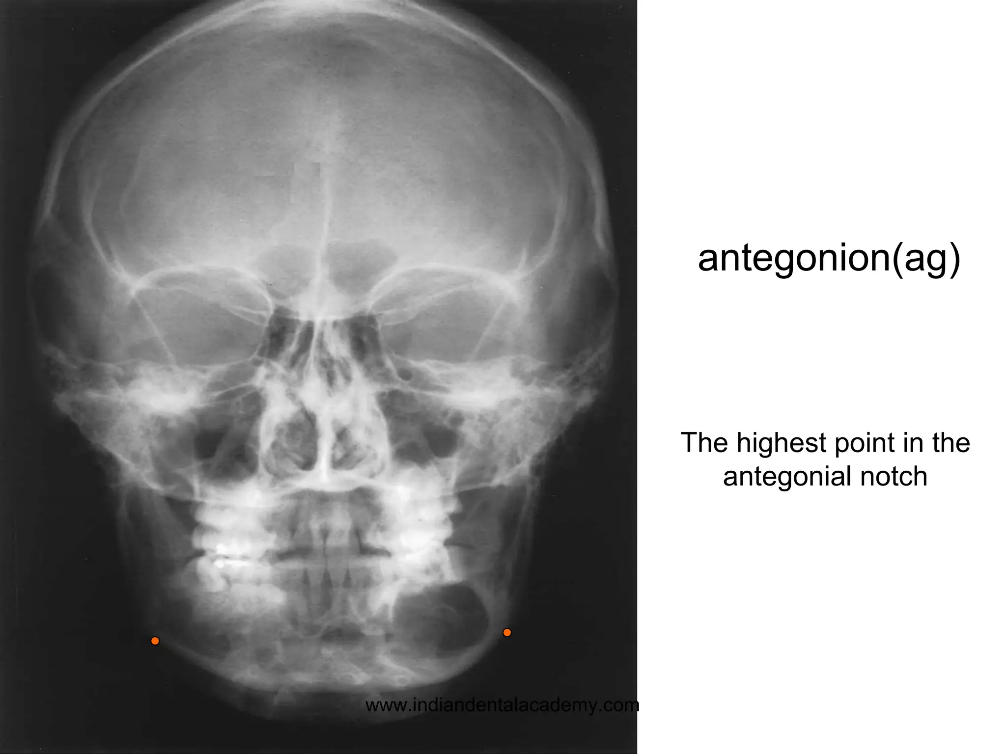 The highest point in the
antegonial notch
antegonion(ag)
www.indiandentalacademy.com
 
