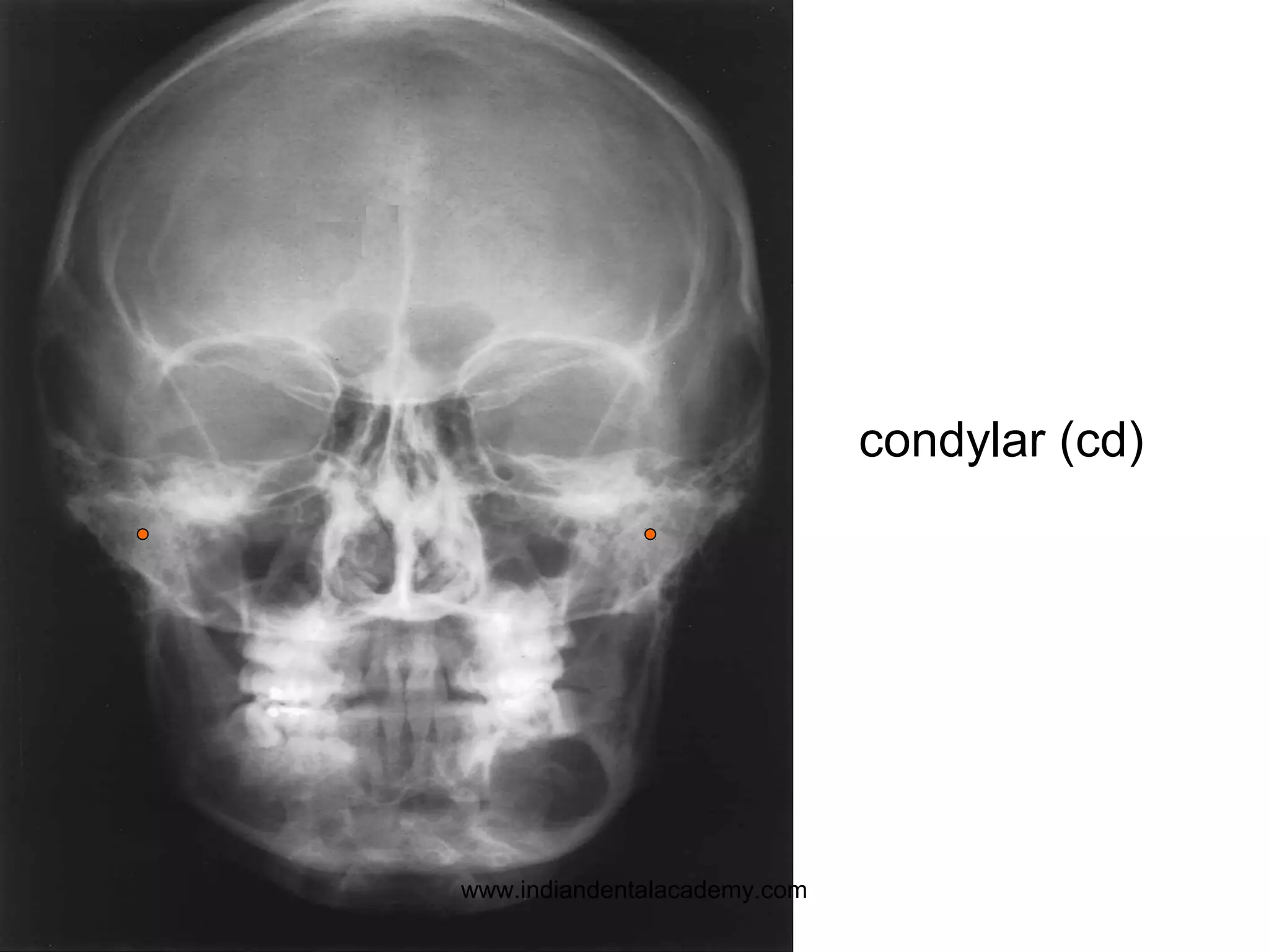 condylar (cd)
www.indiandentalacademy.com
 