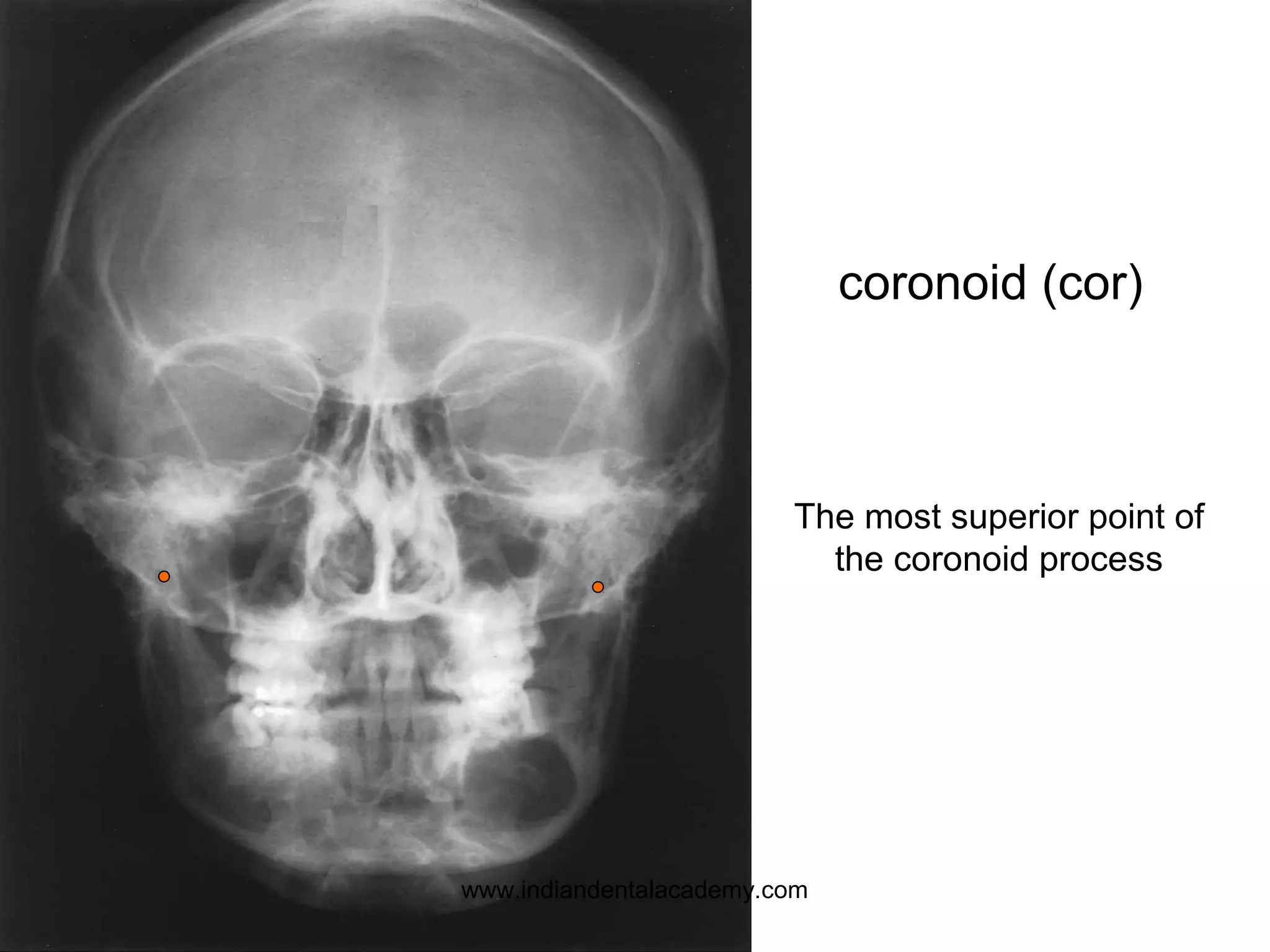 The most superior point of
the coronoid process
coronoid (cor)
www.indiandentalacademy.com
 
