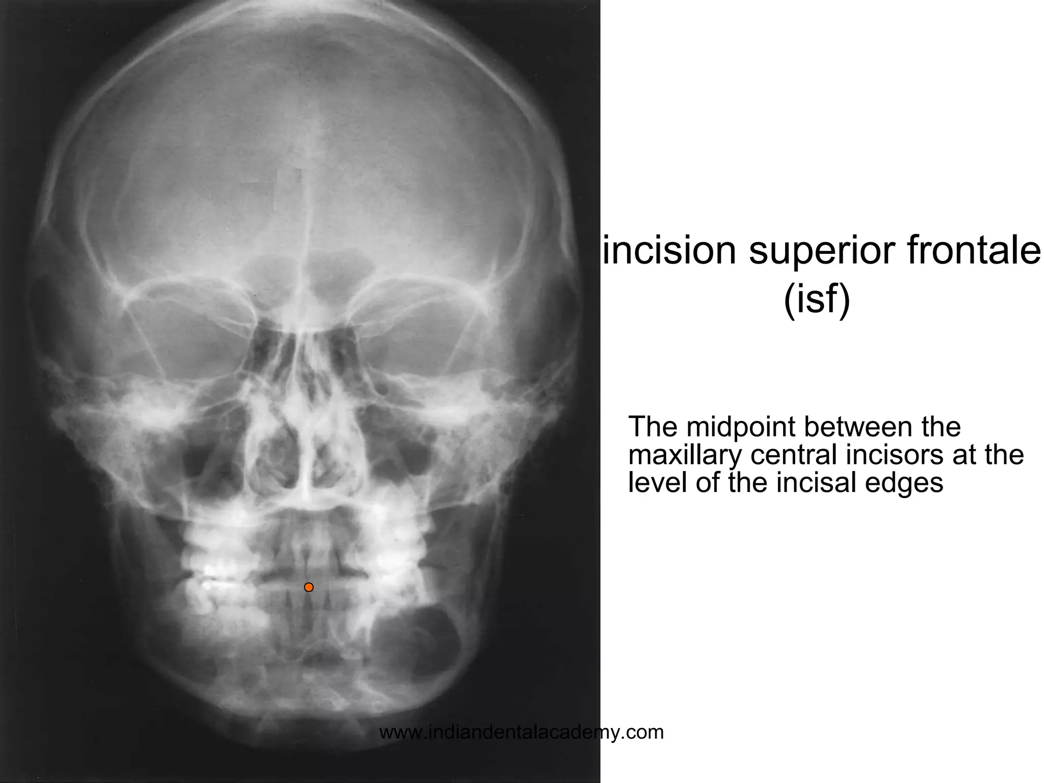 The midpoint between the
maxillary central incisors at the
level of the incisal edges
incision superior frontale
(isf)
www.indiandentalacademy.com
 